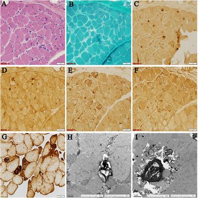 Case Report: A Novel Splice-Site Mutation in DNAJB6 Associated With Juvenile-Onset Proximal–Distal Myopathy in a Chinese Patient